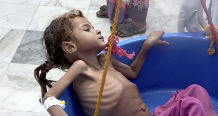 Amal Hussein, 7, whose name means "hope" in Arabic, is weighed at a Yemeni health center in August. (AP File Photo/Hammadi Issa)